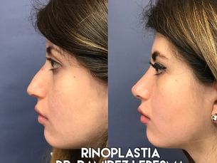 Rinoplastia $20,000. pesos