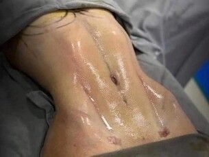 Lipoescultura en pagos fijos mensuales desde 4mil pesos