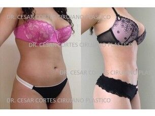 15% DESCUENTO en cirugías  por BUEN FIN