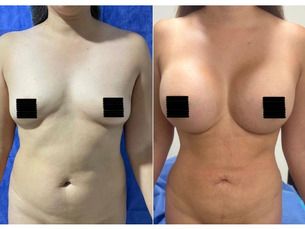 ✨ Promoción espcial ABDOMINOPLASTIA por $70.000✨