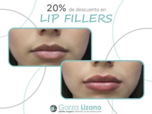 20% de descuento Lips Fillers