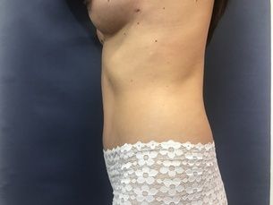 Abdominoplastia $49,000. pesos M.N.