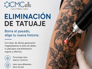 Eliminacion de tatuajes no deseados