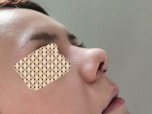 Desde 2500 pesos mensuales cirugía de nariz estética