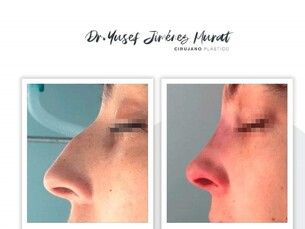 Promo, Rinoplastia 10% de descuento