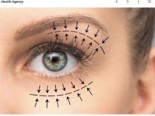 Blefaroplastia Inferior de $25,000 a $20,000