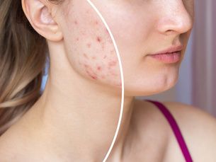 Adiós Cicatrices con EndyMed – Resultados Reales y Rápidos