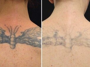 ✨ ¡Elimina tu Tatuaje con Láser ND YAG a Precio Especial! ✨