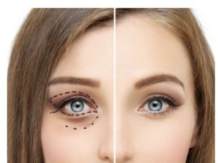 Blefaroplastia Inferior de $25,000 a $18,000