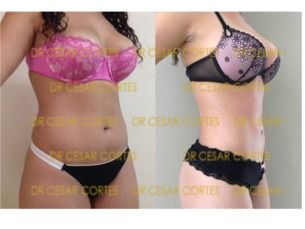 Lipoescultura en pagos fijos mensuales desde 5mil pesos