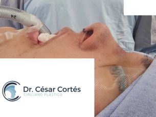 Gratis tratamiento facial con Láser CO2 al operarte de cirugía de nariz