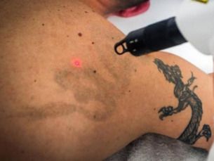 Retiro de tatuajes con Láser desde 500 pesos