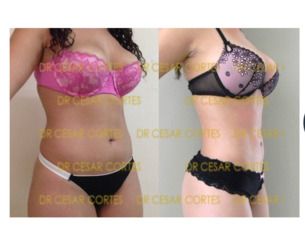 Si te operas de lipoescultura del cuerpo te regalamos la de papada o brazos