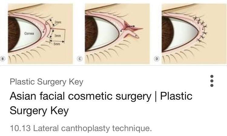 Cirugía para agrandar el contorno del  ojo (hacer el ojo más grande) - 2994