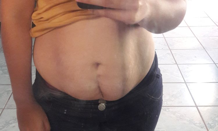 Me pueden realizar una abdominoplastia en IMSS - 4359