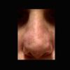 Pocitos en punta nasal después de tercera rinoplastia - 4682