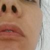 Fosas nasales desiguales después de rinoplastia