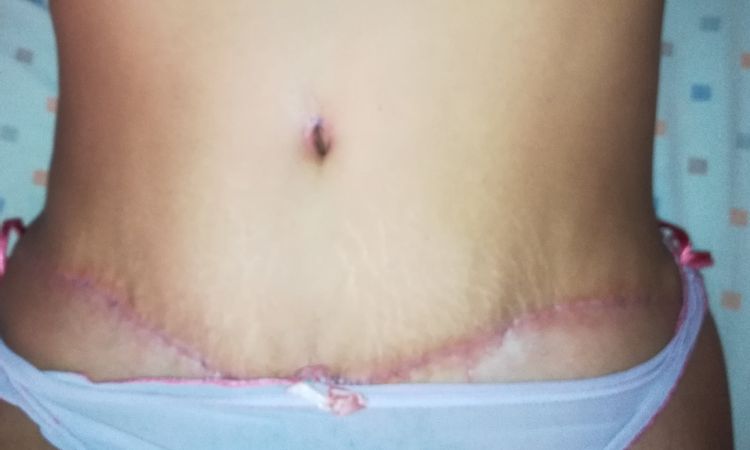 Ya puedo hacer ejercicio a casi 2 meses de abdominoplastia?? - 5540