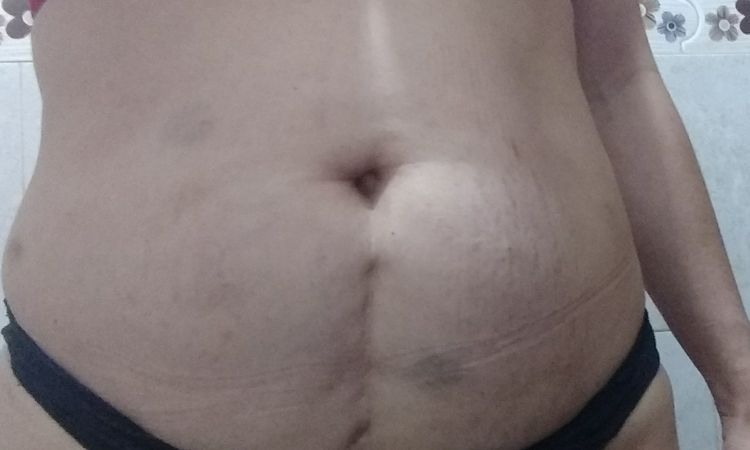 Mini abdominoplastia - 5784