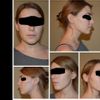 la mentoplastia podria arreglar una asimetria facial ? - 5919