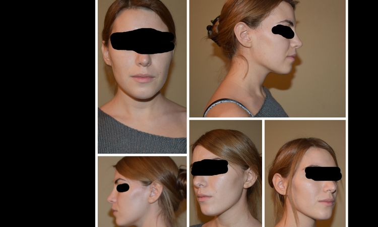 la mentoplastia podria arreglar una asimetria facial ? - 5919