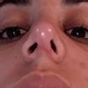 Mi nariz quedo desviada luego de rinoplastia - 6220
