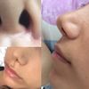 Fosas nasales en forma de triangulo después de rinoplastia