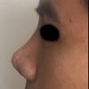 No me gusta como se ve mi nariz después de la rinoplastia - 6249
