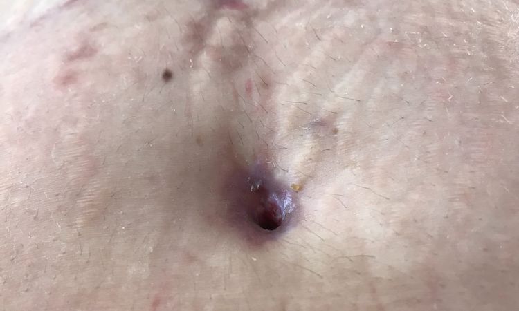 Como evitar que mi ombligo se cierre después de una abdominoplastia - 6325