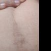 Quitar cicatriz de cesarea