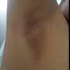 Presupuesto de despigmentacion de axilas?