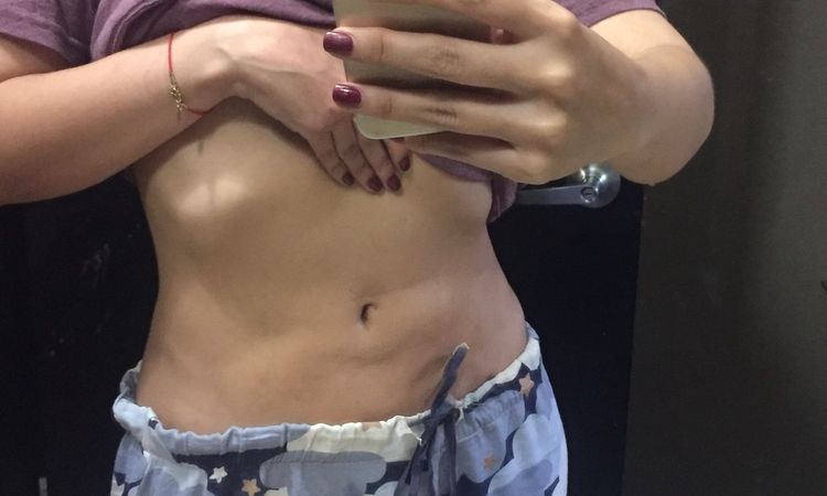 Fibrosis después de minilipo en abdomen - 6530