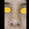Fosas nasales asimétricas - 6563