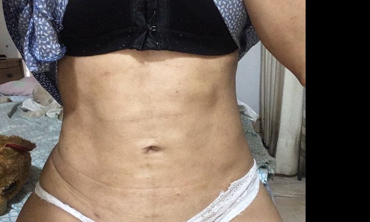 Fibrosis post lipo después de casi 3 meses - 6592