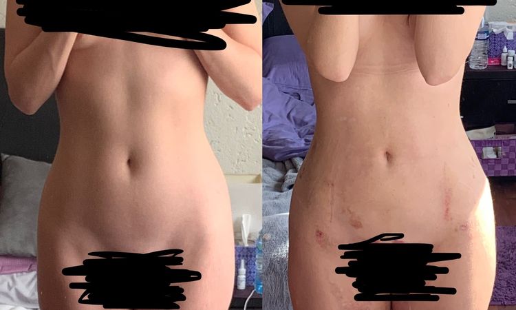 Inflamacion caderas y piernas tras liposuccion - 6623
