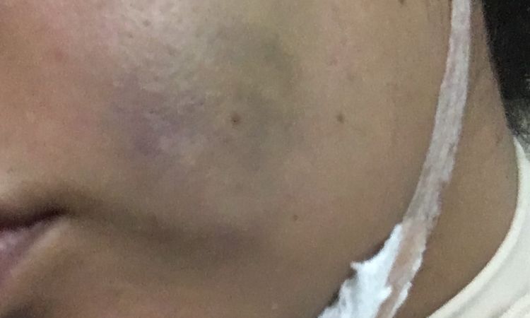 Hematomas verdes post bichectomia - 6887