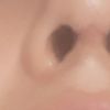 Cuales son los signos o sintomas de una necrosis nasal ?