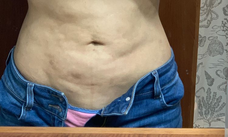 Que aparatologia me sirve para la fibrosis, me hice Lipo hace año y medio - 6956