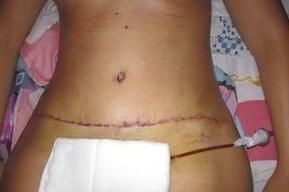 Ejercicio tras abdominoplastia - 7499