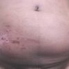 Auxilio!!! Liquido despues de lipo
