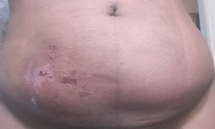 Auxilio!!! Liquido despues de lipo - 7595