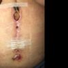 Me urge saber que hacer, herida abierta Después de necrosis y reparación 2 veces