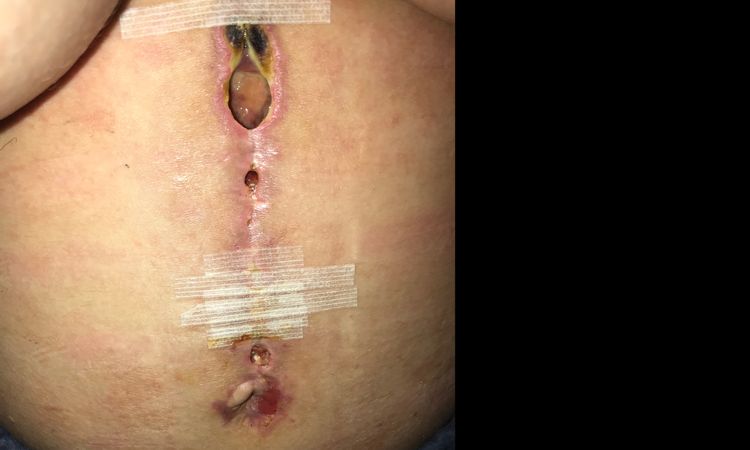 Me urge saber que hacer, herida abierta Después de necrosis y reparación 2 veces - 7686