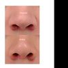 Aletas nasales pegadas de forma torcida hacia dentro - 7763