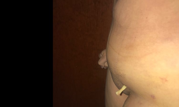 Se me inflamó el abdomen bajo, después de lipo. - 7945