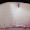 Cicatriz queloide abdominoplastia