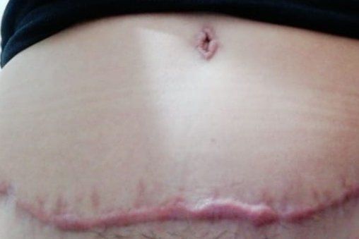 Cicatriz queloide abdominoplastia - 7953