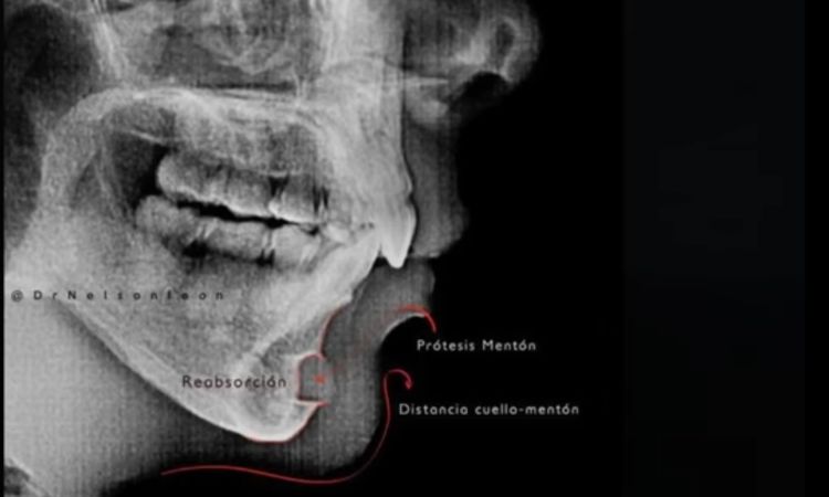 El implante de silicona en el mentón se reabsorbe por el hueso de la quijada - 8237