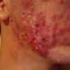 El láser CO2 me sirve para el acne quistico?