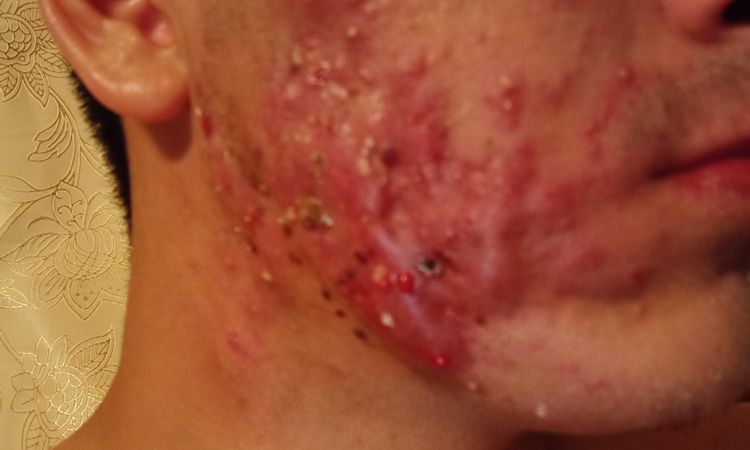 El láser CO2 me sirve para el acne quistico? - 8286